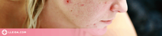 Un estudi revela que els bacteris de la pell poden segregar i produir molècules per tractar l'acné