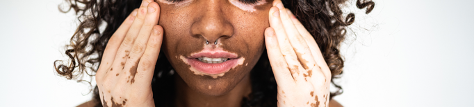 El vitiligen: una malaltia autoimmune que afecta el color natural de la pell