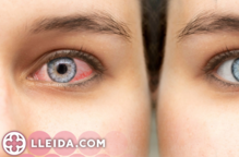Les causes darrere dels ulls vermells: quan preocupar-se?