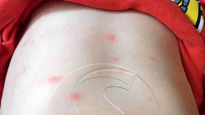 La varicel·la 'ataca' de nou