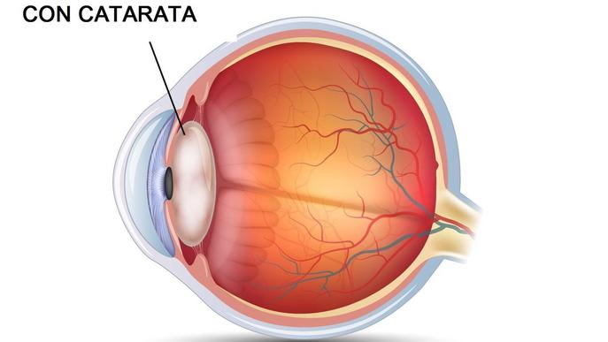 Com es manifesten les cataractes?