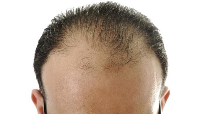 Fins a quin punt ens hem de preocupar per la caiguda de cabell?