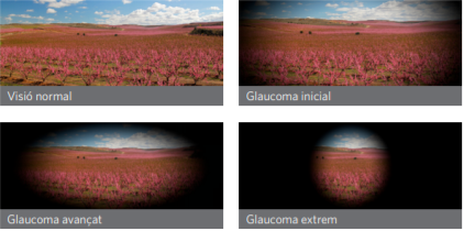 Glaucoma: Símptomes, Prevenció i Tractament