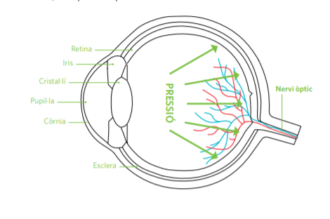 Glaucoma: Símptomes, Prevenció i Tractament