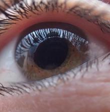 Com podem preveure el despreniment de retina?