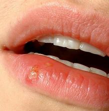 Quan pot aparèixer un herpes labial?