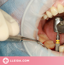 7 coses que no pots ignorar dels implants dentals