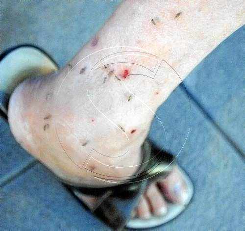 Els veïns de Palauet, cosits a picades pels mosquits