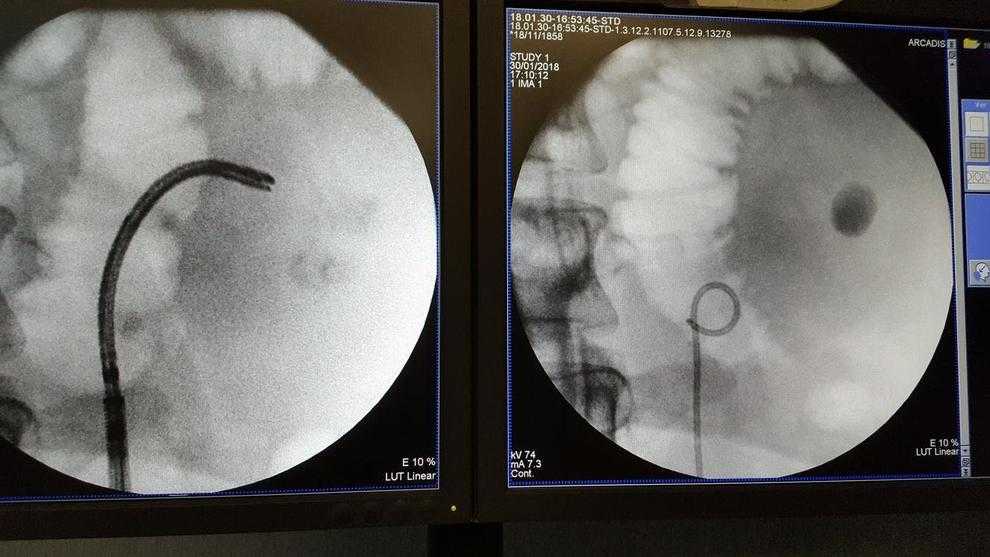 Tècnica pionera a Lleida per eliminar grans pedres del ronyó sense cirurgia