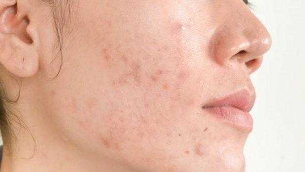 Com podem deslliurar-nos de l’acne?