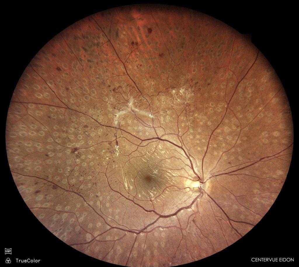 Retinopatia diabètica: definició, causes i tractament
