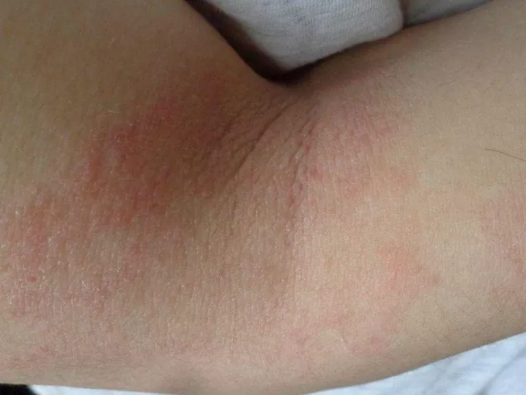 És hereditària la dermatitis atòpica?
