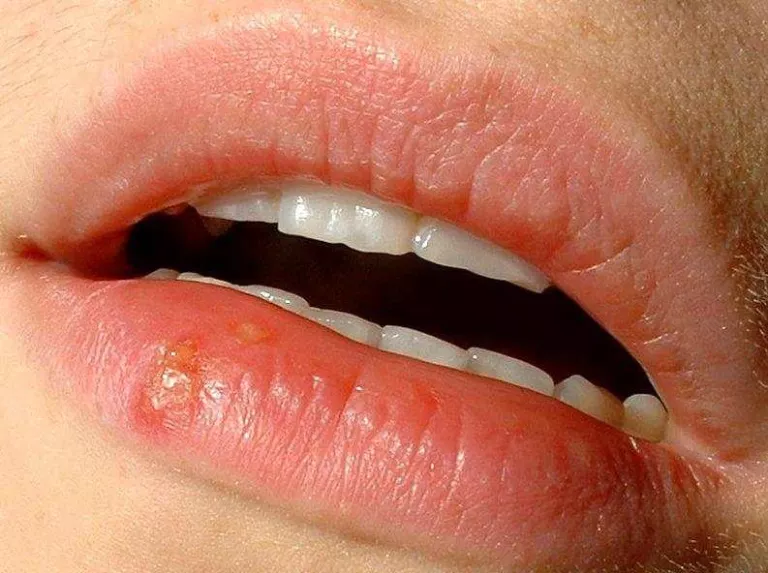 Quan pot aparèixer un herpes labial?