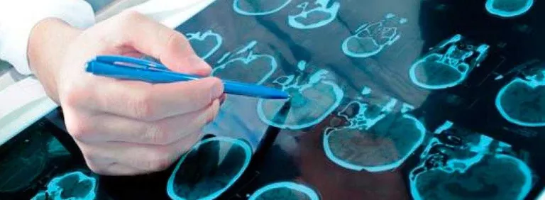 L'ictus es pot evitar en el 80% dels casos: 10 coses que has de saber sobre ell