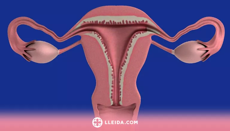 ℹ️ Què és l’endometriosi?