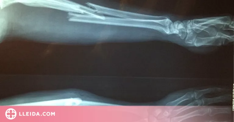 Quines són les causes de l’osteoporosi?