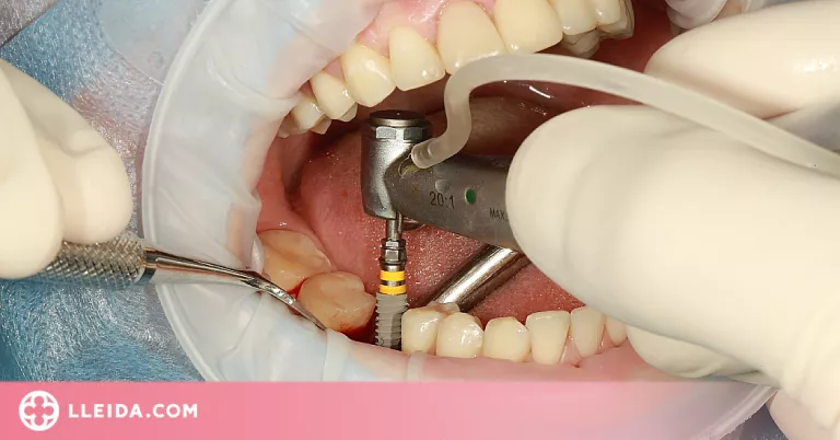 7 coses que no pots ignorar dels implants dentals
