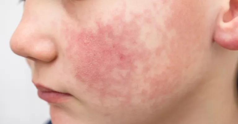 El Virus de la Bufetada: què és i com es tracta