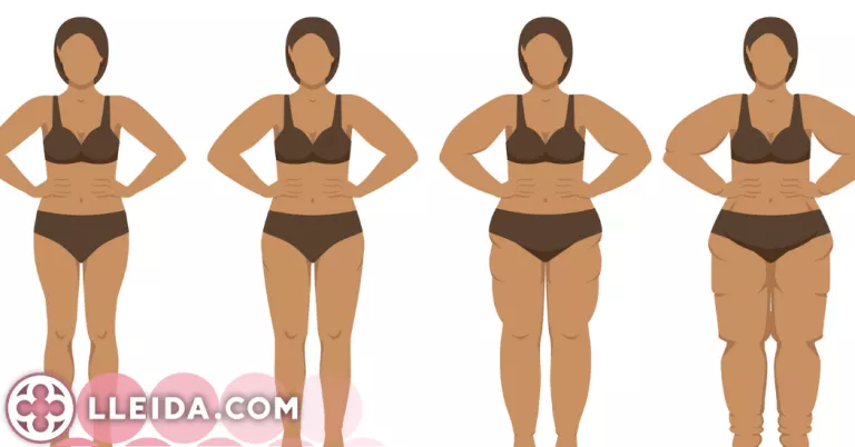 El lipedema, la malaltia que afecta majoritàriament dones