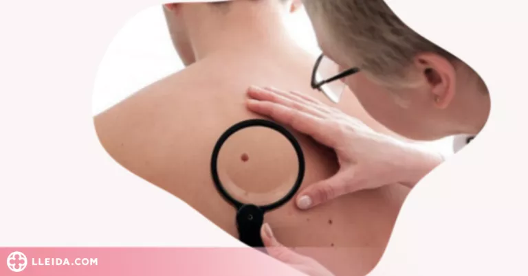 Cinc especialistes en dermatologia de Lleida participen en la campanya Euromelanoma 2022 sobre càncer de pell