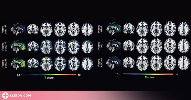 Nous avenços per captar millor els primers indicis de l'Alzheimer
