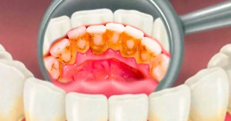 Com puc prevenir el carrall a les dents?