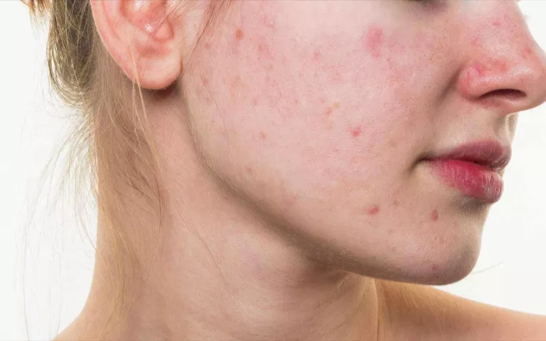 Les píndoles anticonceptives milloren l'acne?