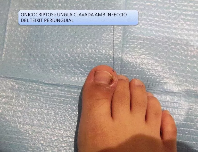 ONICOCRIPTOSI